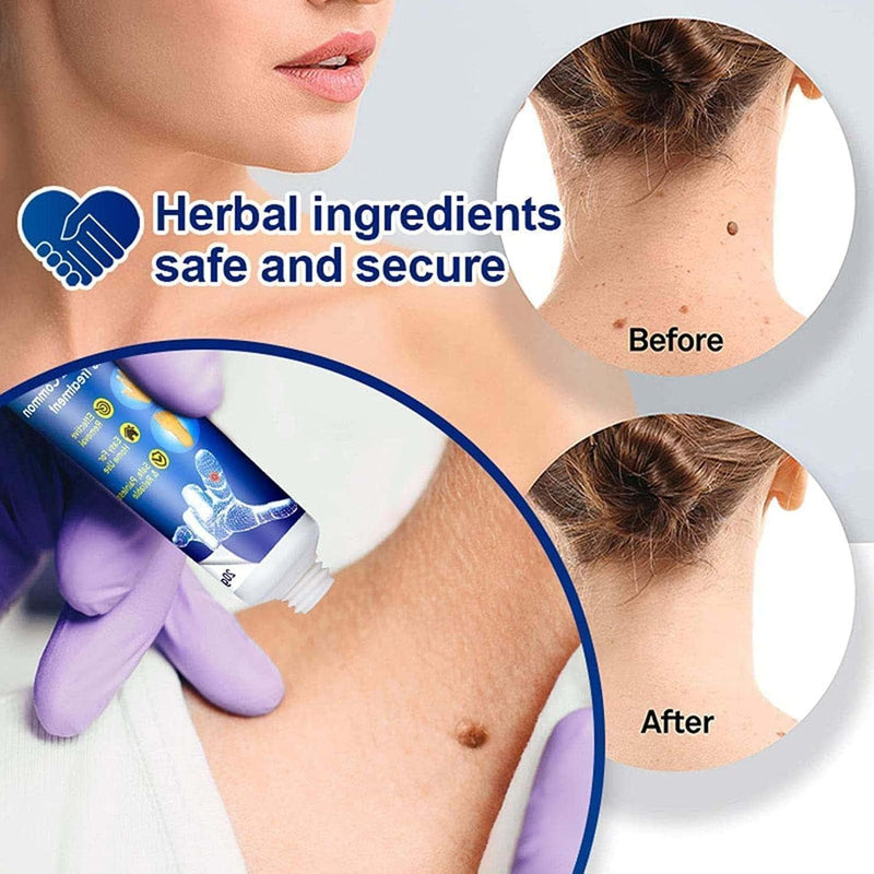 Wart Remover Ointment for Wart Removal ( Pack Of 1 )